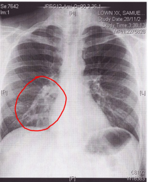 пневмония  на  рентгенограмме